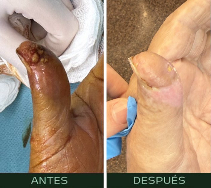 cirugia-reconstructiva-mano-dedo-2