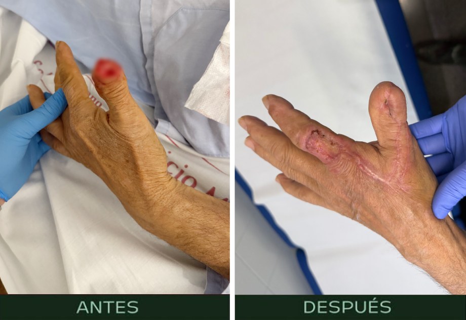 cirugia-reconstructiva-mano