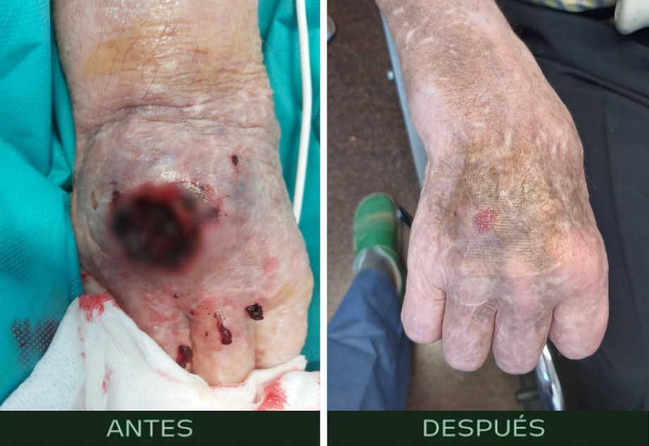 cirugia-reconstructiva-ulcera-herida-mano-cens