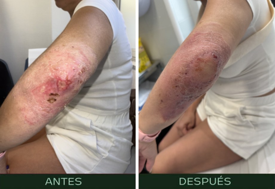 cirugia-reparadora-reconstructiva-codo