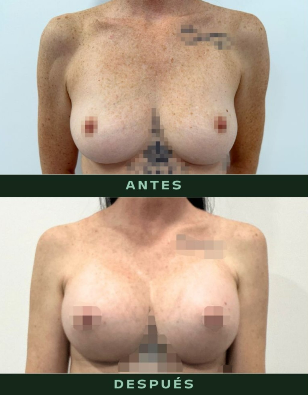 drmartinezalfaro-aumento-pecho-1