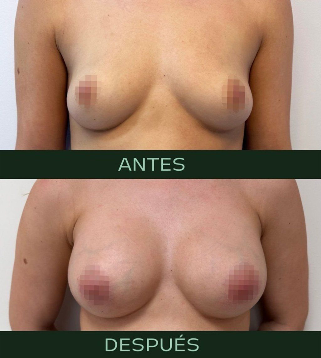 drmartinezalfaro-aumento-pecho-2