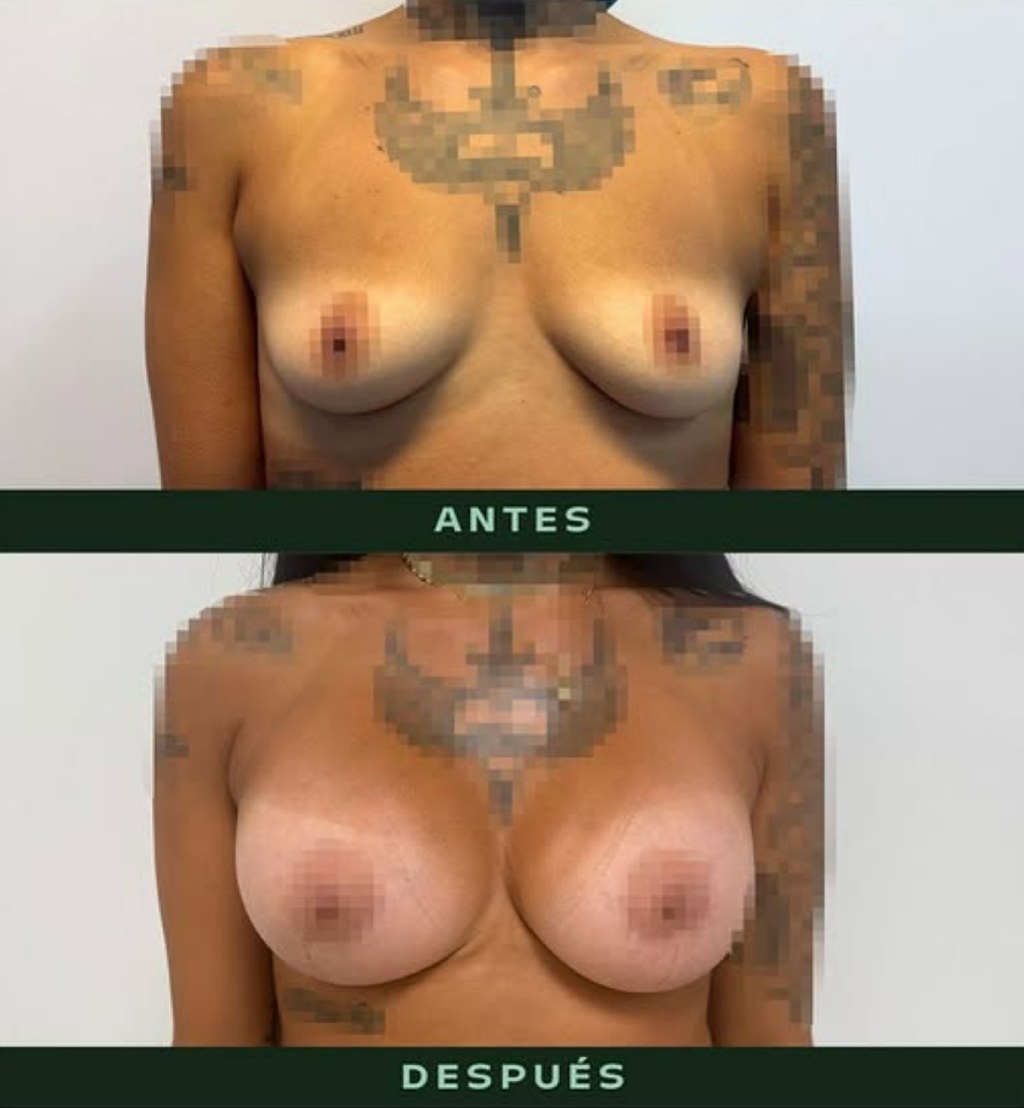 drmartinezalfaro-aumento-pecho-3