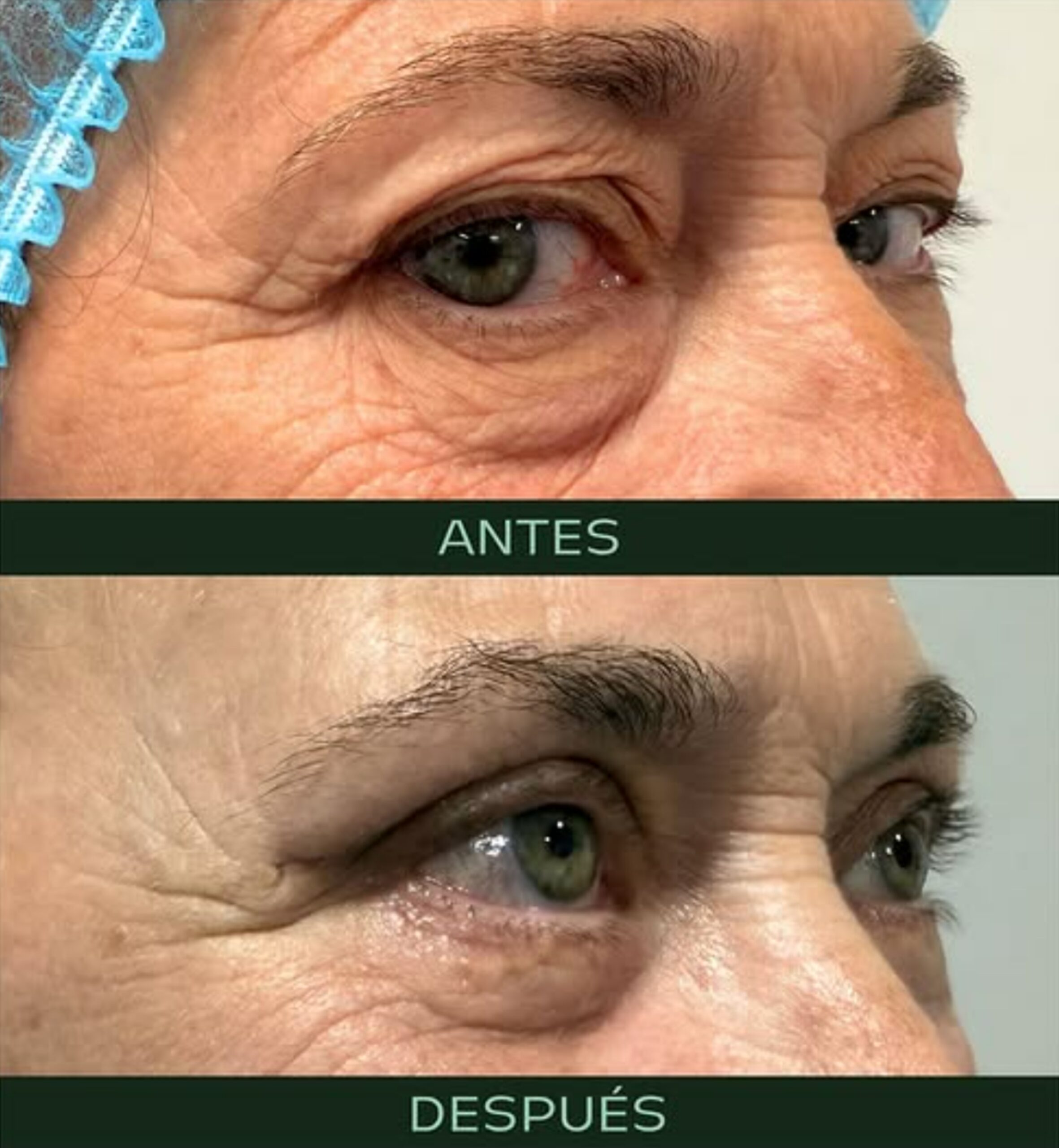 drmartinezalfaro-blefaroplastia-2