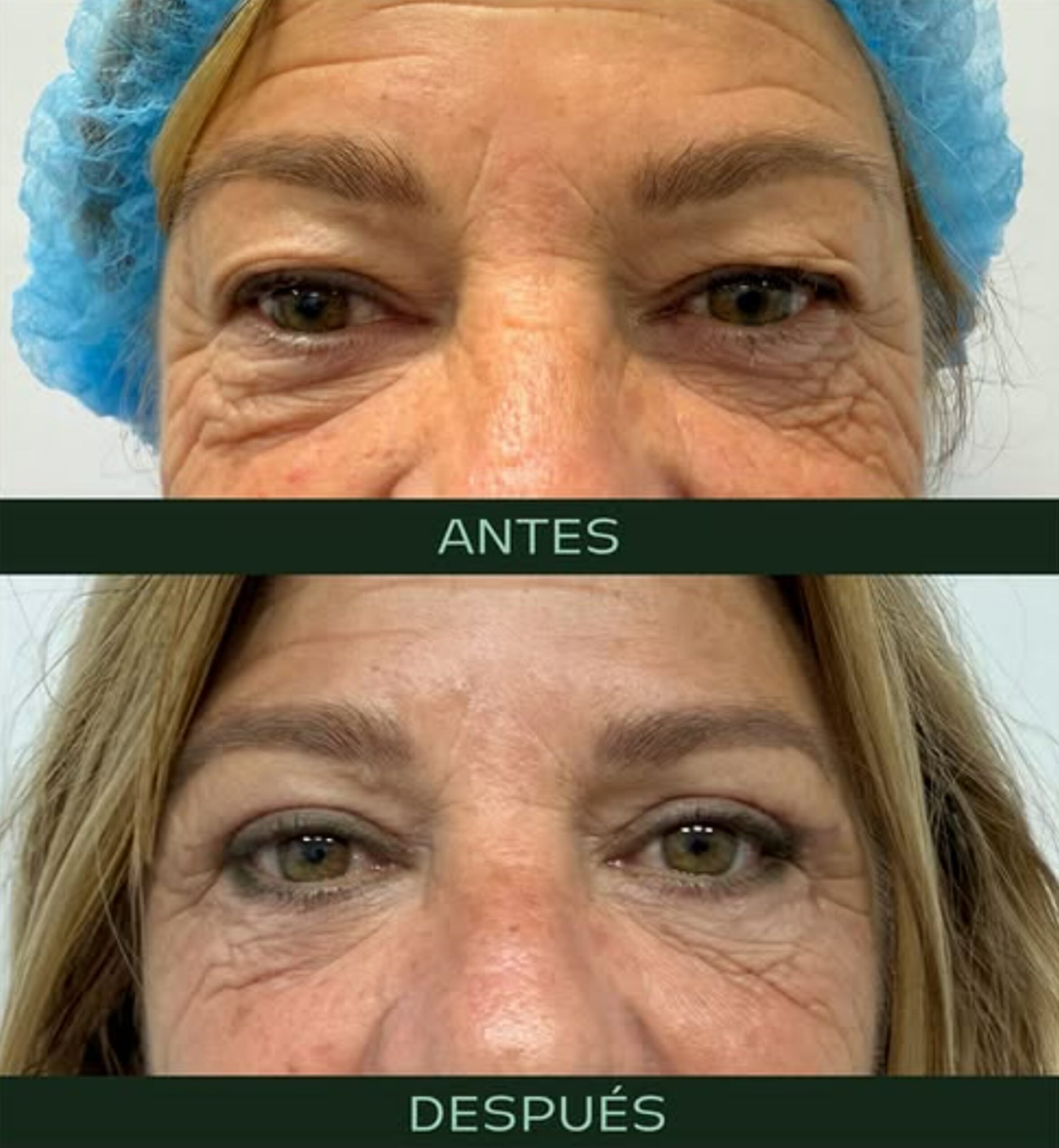drmartinezalfaro-blefaroplastia-b1