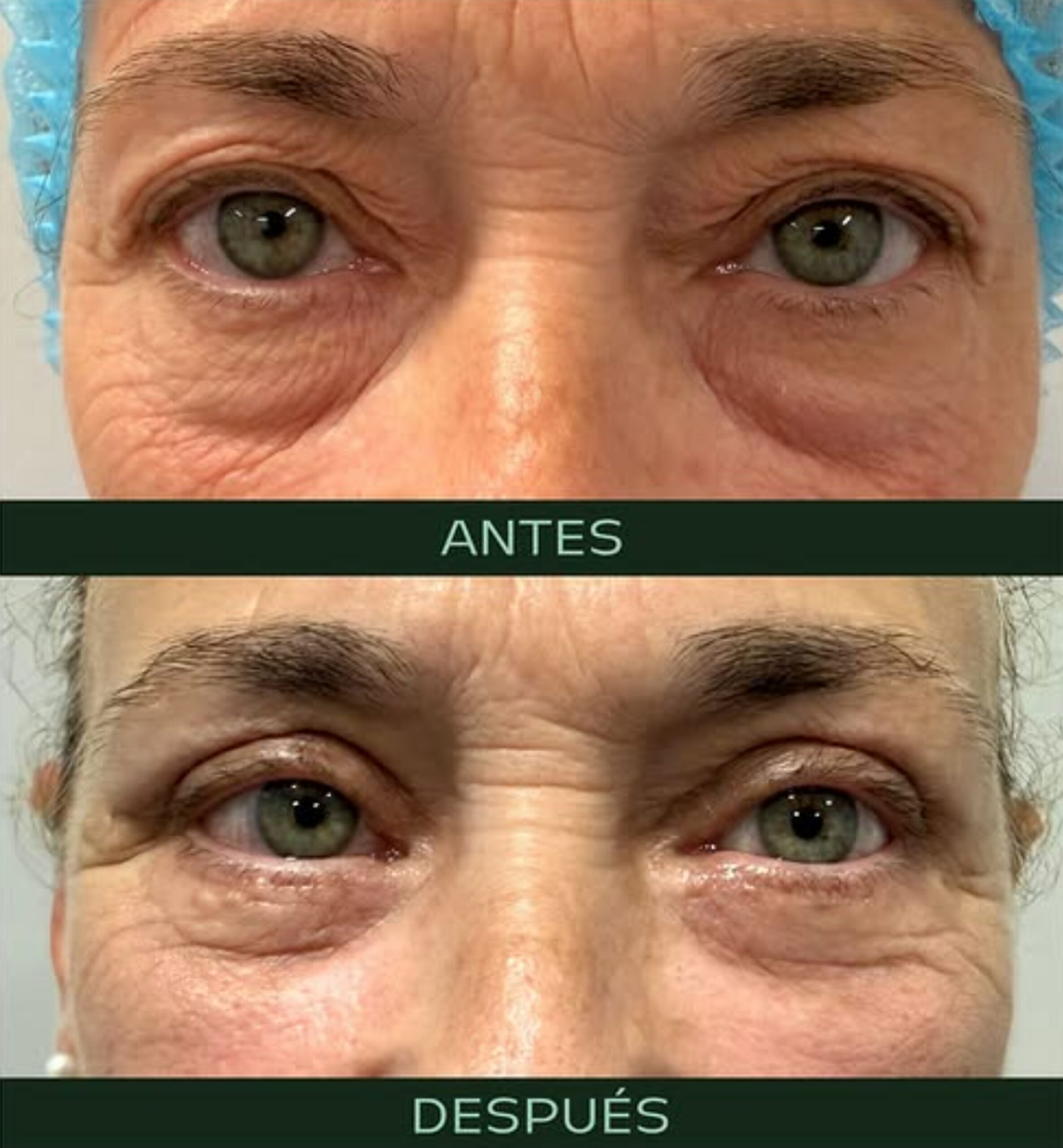 drmartinezalfaro-blefaroplastia