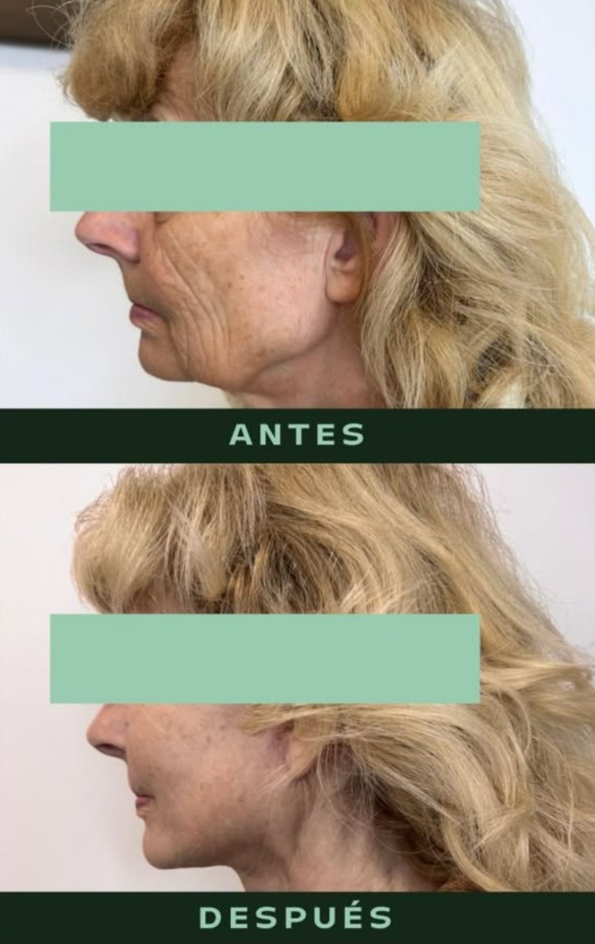 drmartinezalfaro-lifting-cervicofacial-1