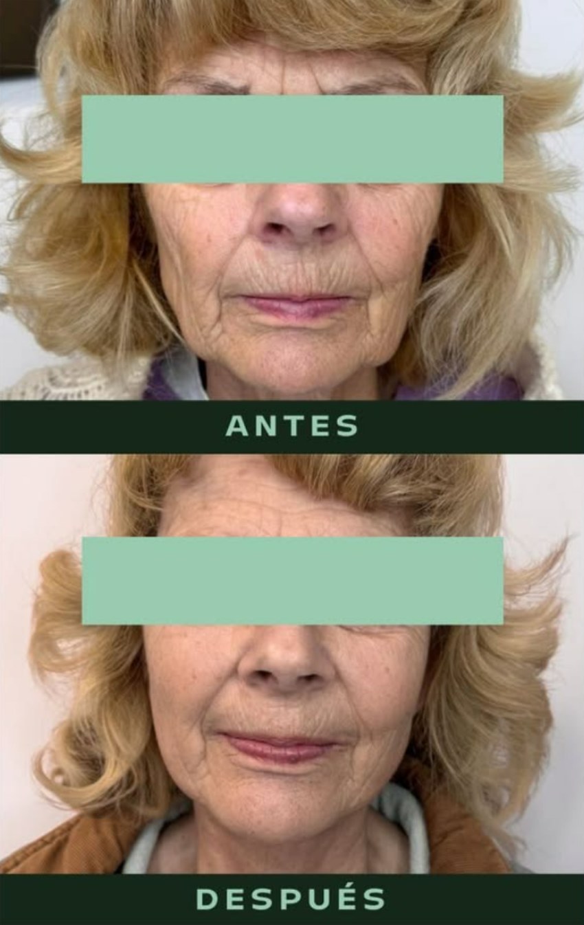 drmartinezalfaro-lifting-cervicofacial-2