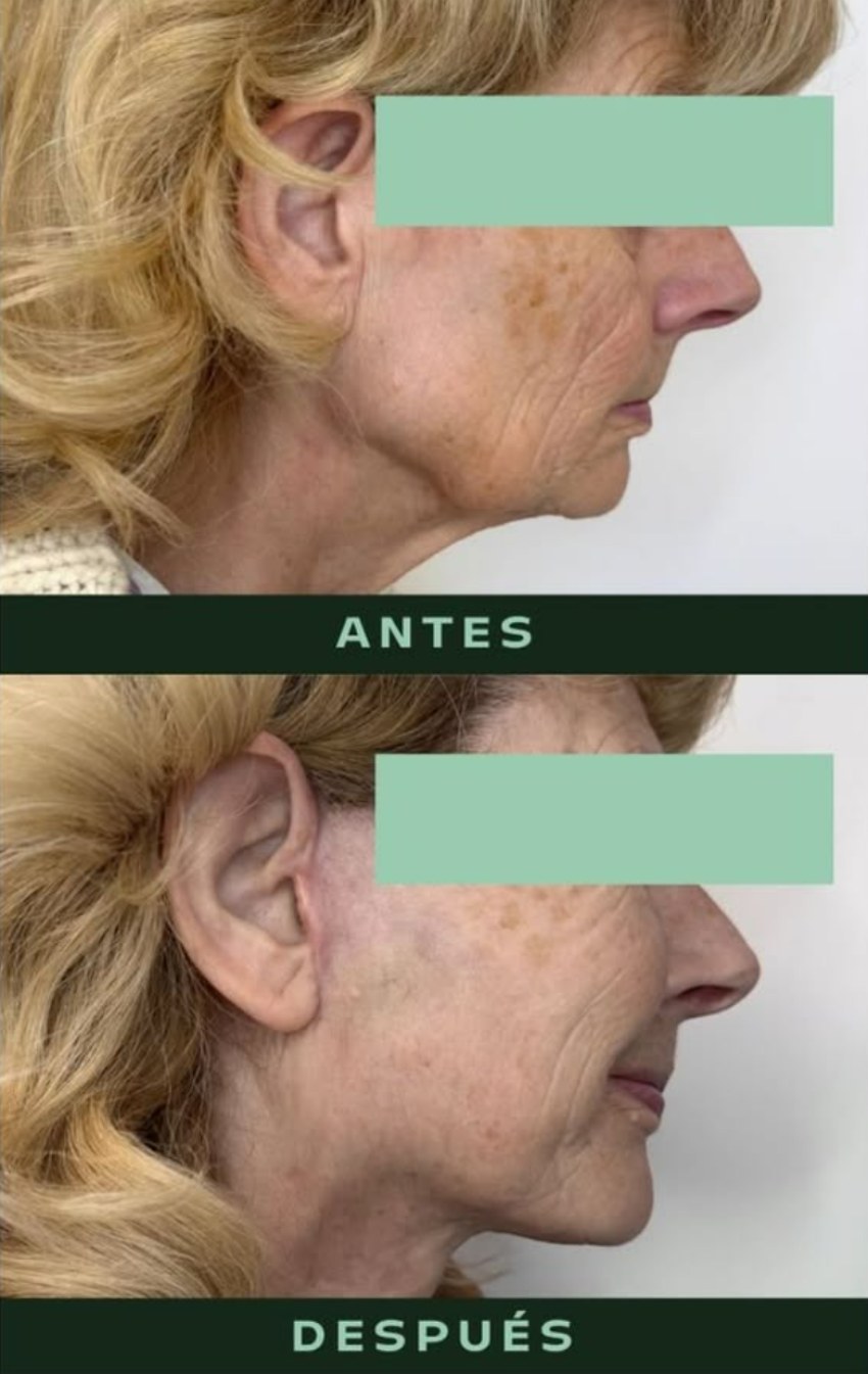 drmartinezalfaro-lifting-cervicofacial-3