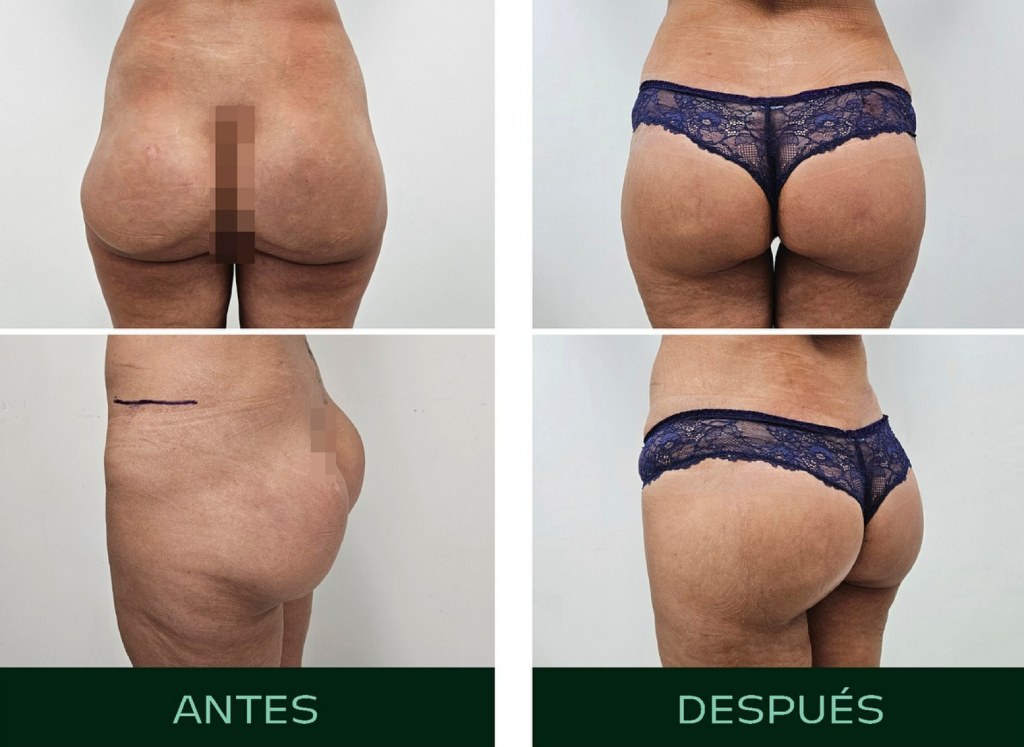 drmartinezalfaro-lifting-gluteo-1