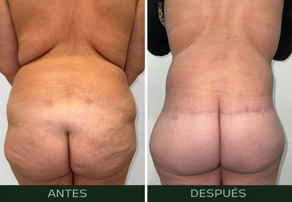 drmartinezalfaro-lifting-gluteo-2