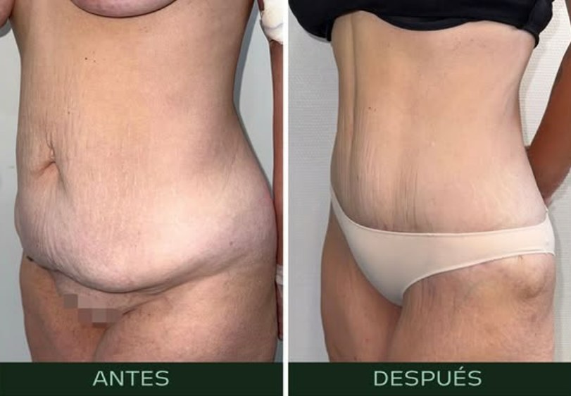 drmartinezalfaro-lipoabdominoplastia (3)
