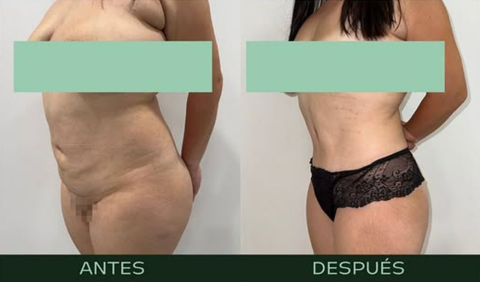drmartinezalfaro-lipoabdominoplastia-b1
