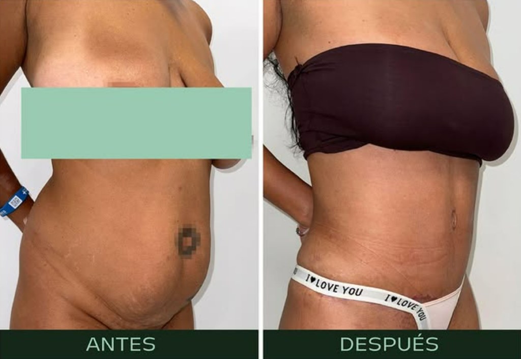 drmartinezalfaro-lipoabdominoplastia-c1