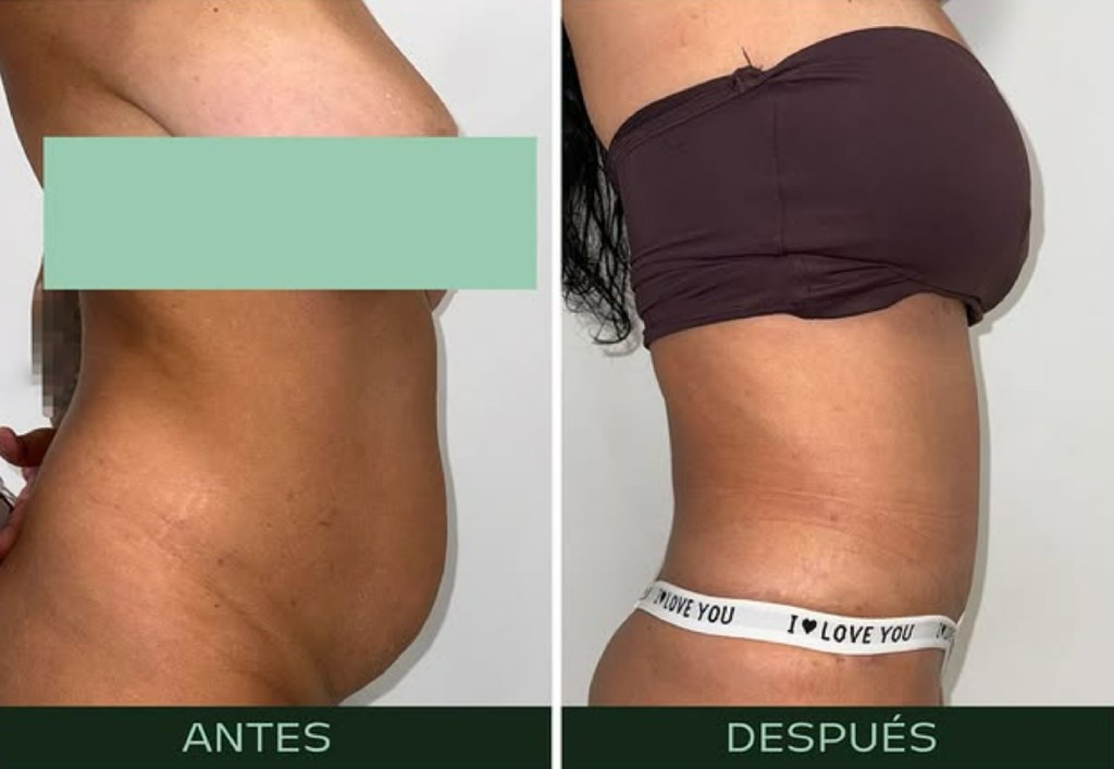 drmartinezalfaro-lipoabdominoplastia-c2