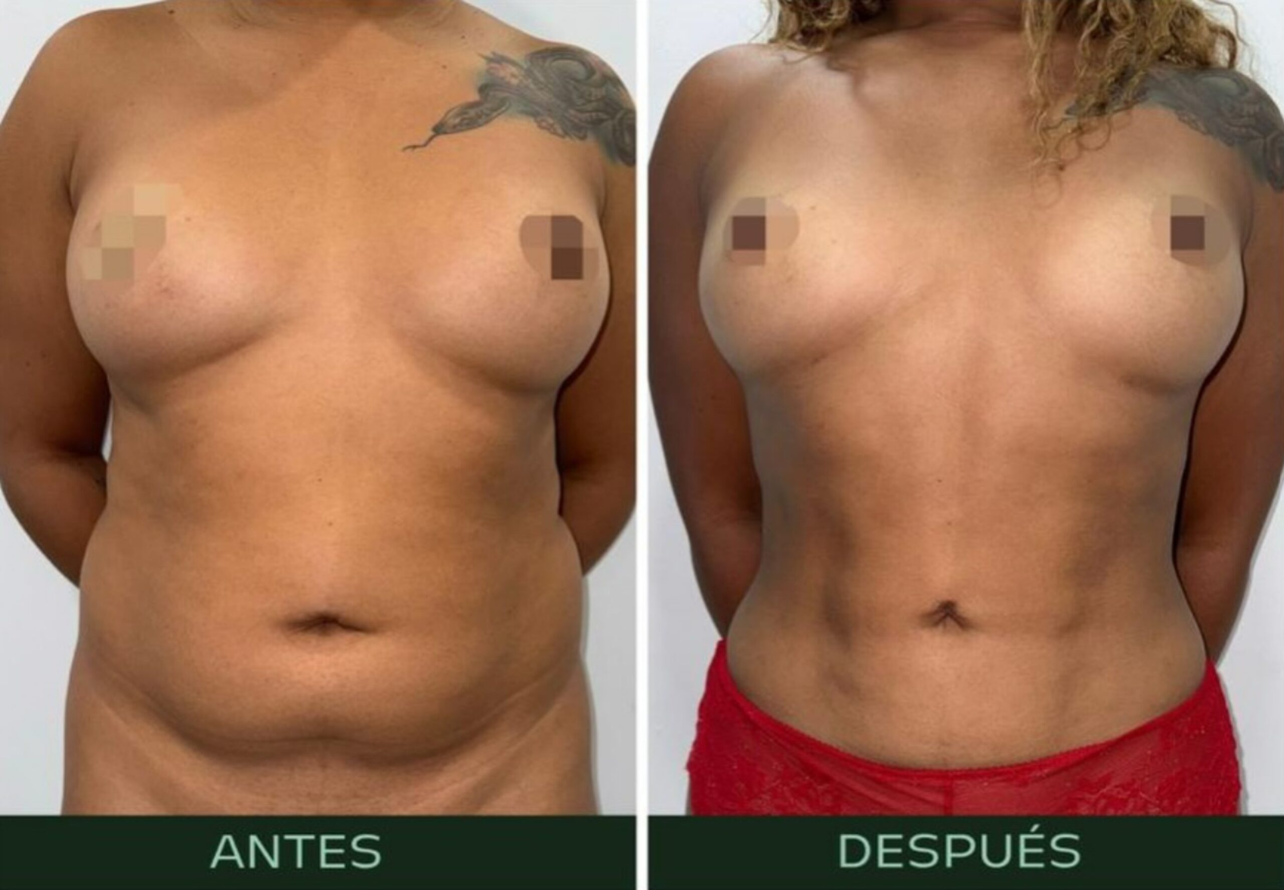 drmartinezalfaro-lipovaser-liposuccion