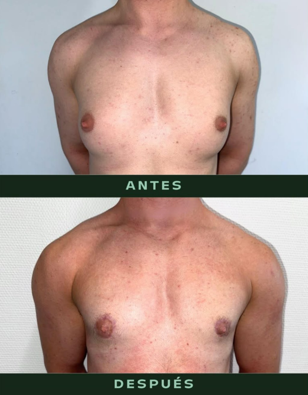 drmartinezalfaro-masculinizacion-toracica-1