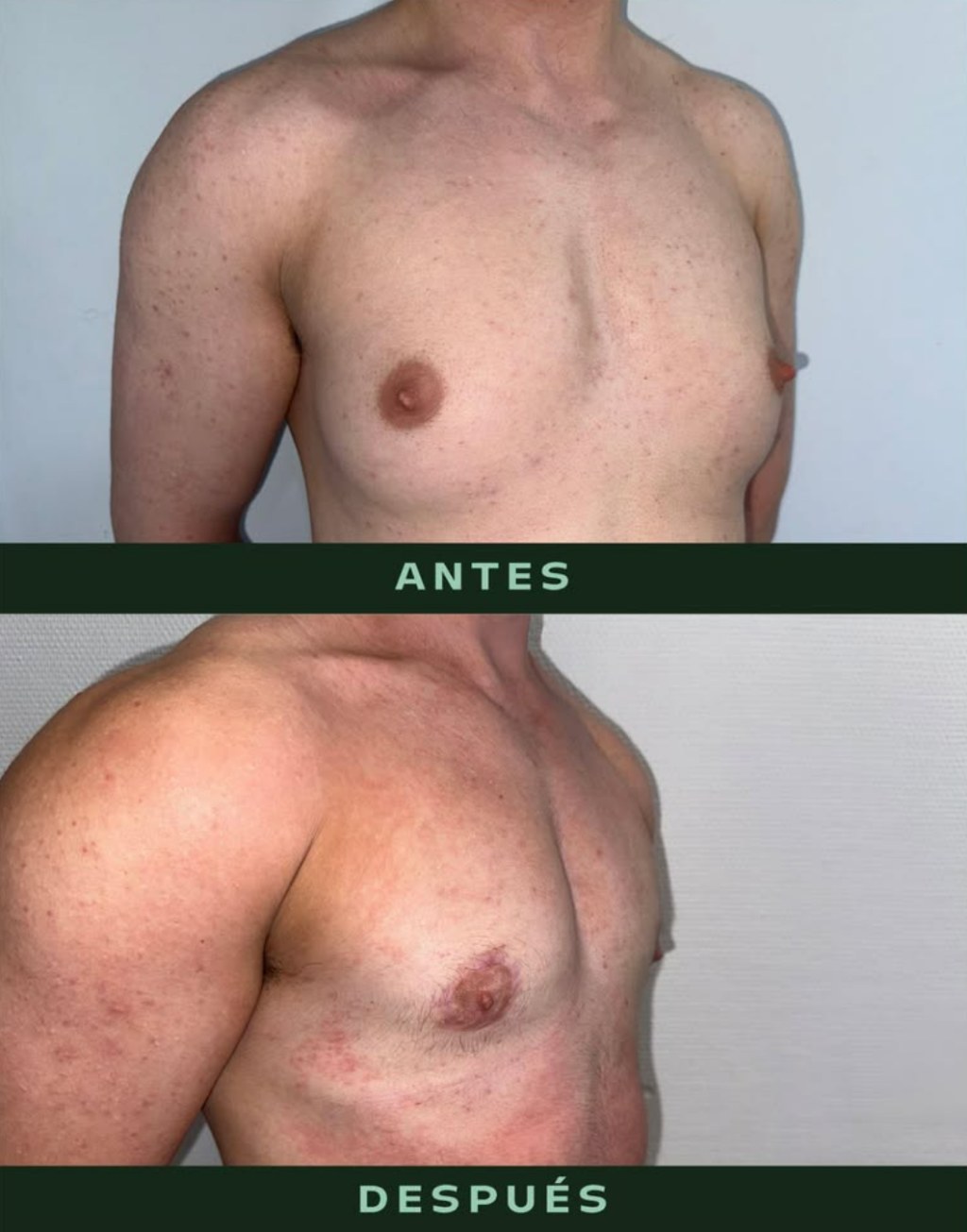 drmartinezalfaro-masculinizacion-toracica-3