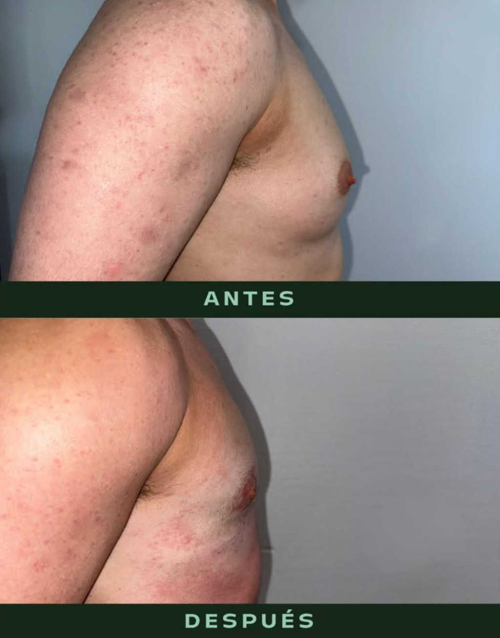drmartinezalfaro-masculinizacion-toracica-4
