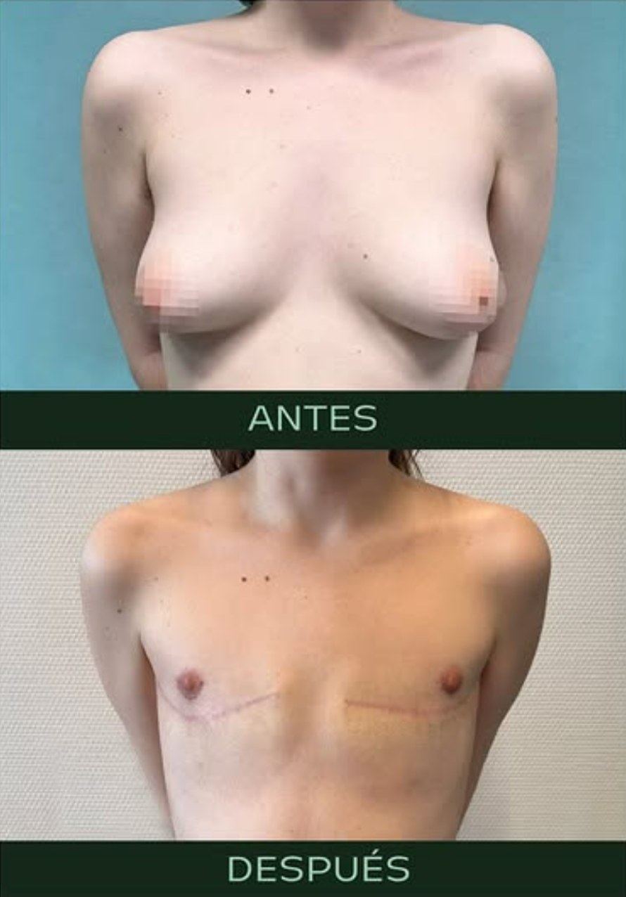 drmartinezalfaro-masculinizacion-toracica-5