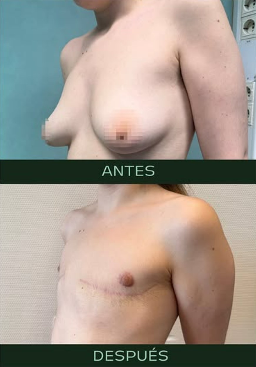 drmartinezalfaro-masculinizacion-toracica-6