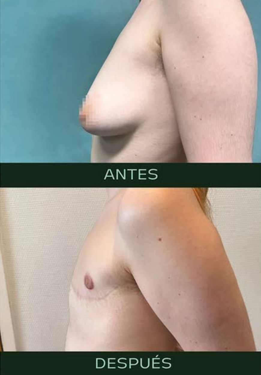 drmartinezalfaro-masculinizacion-toracica-7