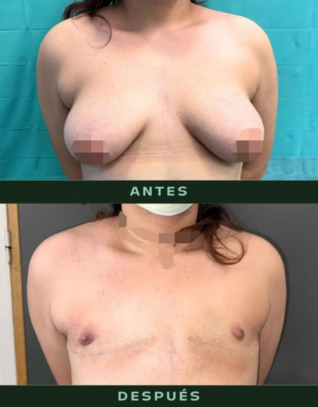 drmartinezalfaro-masculinizacion-toracica-8