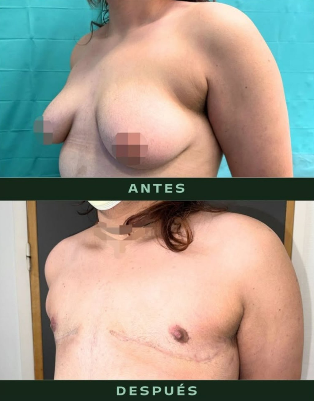 drmartinezalfaro-masculinizacion-toracica-9