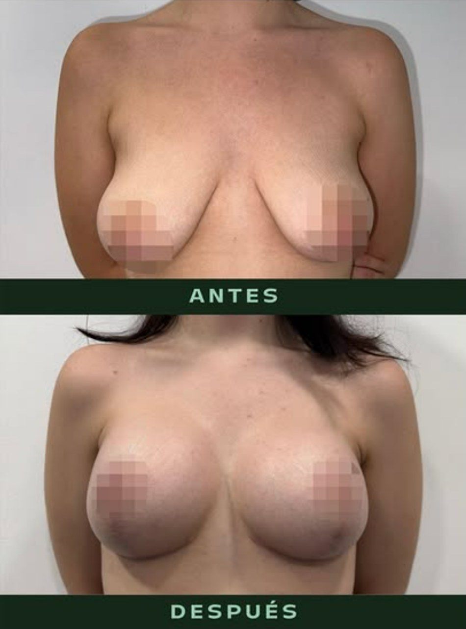 drmartinezalfaro-mastopexia-1