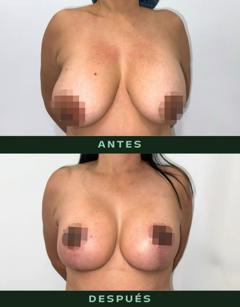 drmartinezalfaro-mastopexia-3