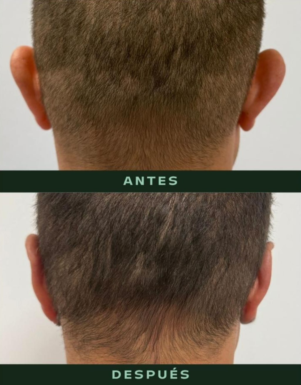 drmartinezalfaro-otoplastia-a1