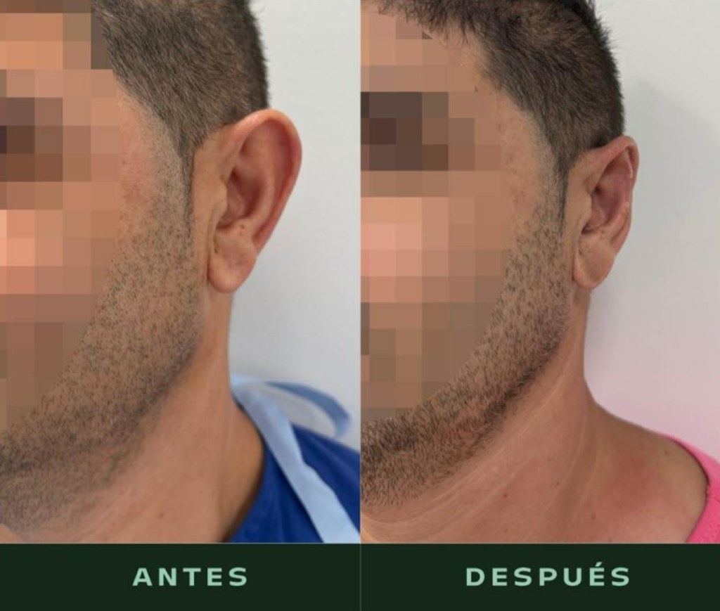 drmartinezalfaro-otoplastia-b1