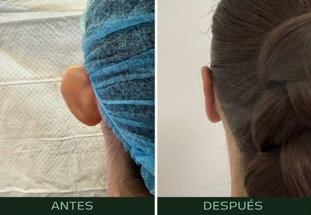 drmartinezalfaro-otoplastia-c1