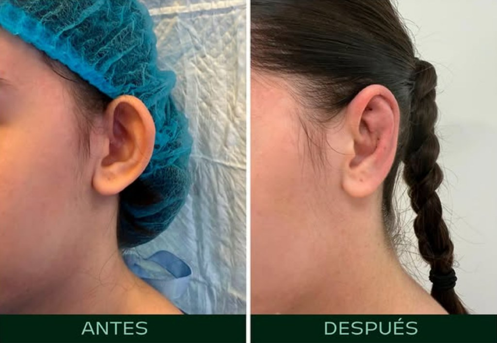 drmartinezalfaro-otoplastia-c2