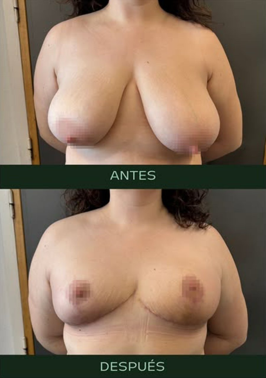 drmartinezalfaro-reduccion-mamas-2