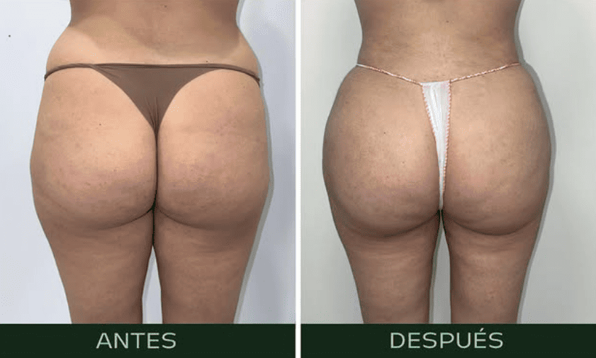 lifting-gluteo