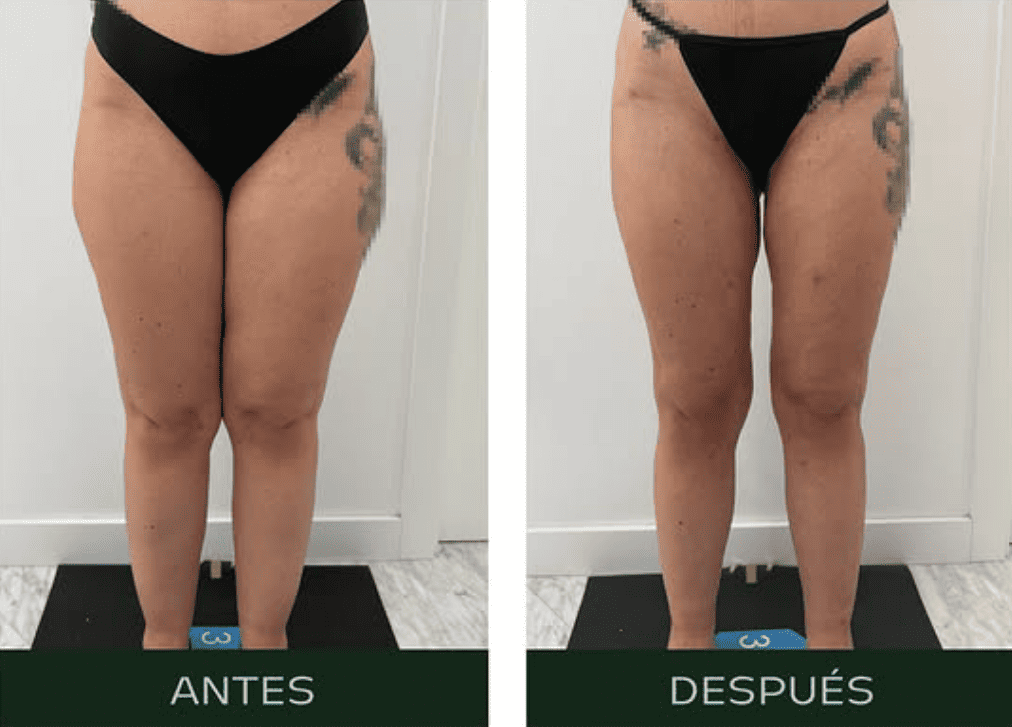 lipedema