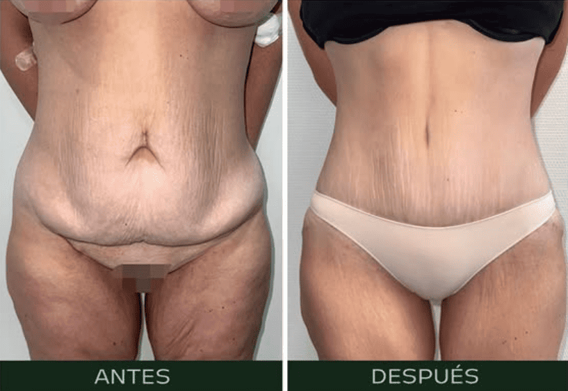 lipoabdominoplastia (1)