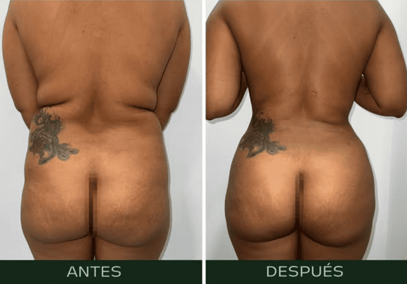 lipofilling (1)
