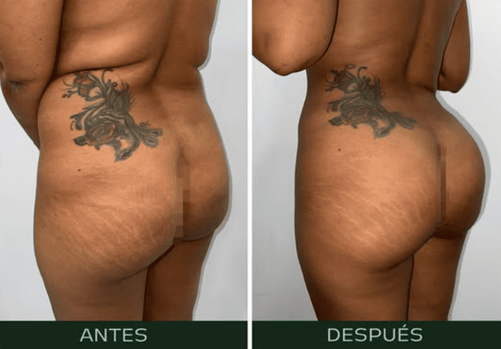 lipofilling (2)