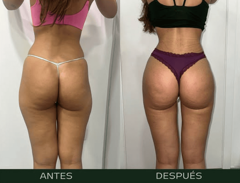 lipofilling-gluteo
