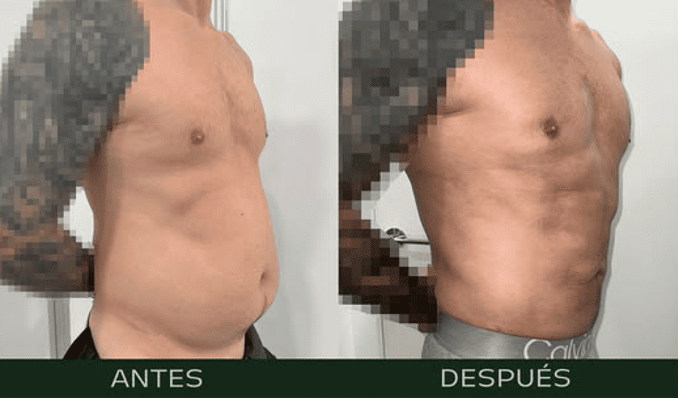 liposuccion-con-marcacion-abdominal (2)