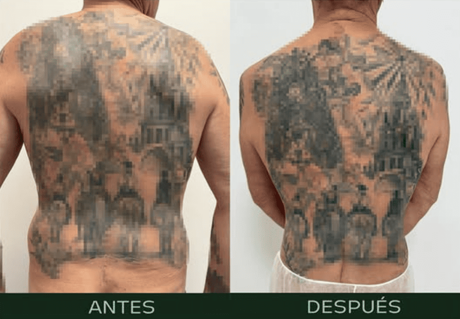 liposuccion-flancos